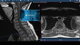 2Minute Neuroscience Amyotrophic Lateral Sclerosis ALS [upl. by Fries194]