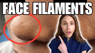 Sebaceous Filaments Vs Demodex Face Mites [upl. by Ewald]