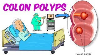 Colonic Polyps [upl. by Ashok16]