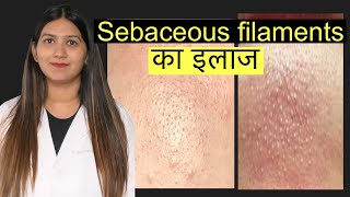 Sebaceous filaments pores on nose treatment in Hindi  नाक पर दिखने वाले पोर का इलाज [upl. by Aifas593]