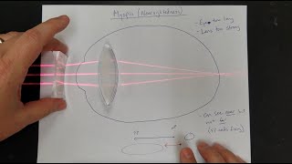 Difference between Myopia Near Sightedness amp Hyperopia FarSightedness [upl. by Mariandi972]