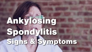 Ankylosing Spondylitis  Signs and Symptoms 2 of 5 [upl. by Annaear]