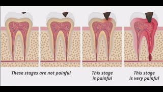 Stages of Tooth Decay Introduction [upl. by Goldsworthy]