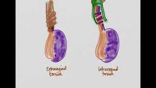 Testicular Torsion [upl. by Cloutman]