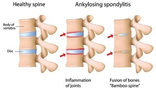 Ankylosing Spondylitis [upl. by Sindee]