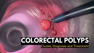 Hyperplastic Polyps Not Always What They Seem [upl. by Reivazx]