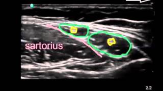 lateral femoral cutaneous nerve [upl. by Millburn845]