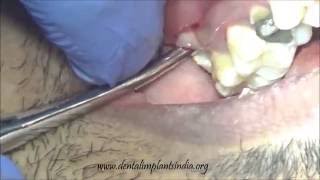 Severely buccoverted upper wisdom tooth extraction [upl. by Sirrep]