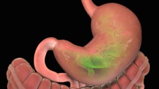 Stomach Ulcer  Nucleus Health [upl. by Ahsilef365]