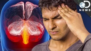 Headache  Overview types signs and symptoms treatment [upl. by Baggs445]