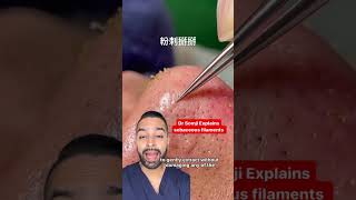 sebaceous filaments nose extraction  Dr MediSpa [upl. by Stine670]