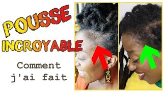 Tempes Comment jai fait repousser mes cheveux des TEMPES  Méthode 100 naturelle alopeciepousse [upl. by Kletter]