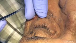 Milia  Stringoma Removal  Periorbital Area [upl. by Lleryt]