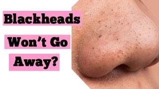 Blackheads on Nose or Sebaceous Filaments  Clogged Pores on Nose  Best Skincare Advice [upl. by Oiralih]