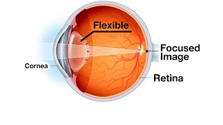 Vision Correction for High Levels of Myopia amp Astigmatism [upl. by Lemrahs]