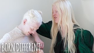 The Besties With Albinism  BORN DIFFERENT [upl. by Feinberg]