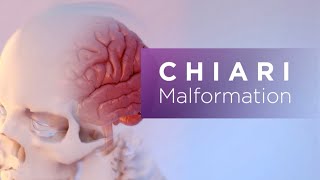 Chiari Malformation [upl. by Gaspar642]