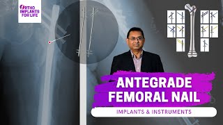 Antegrade Femoral Nail System Surgical Technique [upl. by Charmion318]