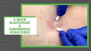 A Back Blackhead amp Seborrheic Keratoses  Dr Derm [upl. by Lirret]