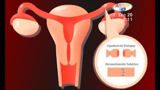 Recanalización de las Trompas de Falopio [upl. by Carlo995]