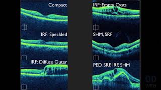 Mayo Clinic Minute Blurry vision as you age [upl. by Einaj474]