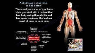 Ankylosing Spondylitis amp The Spine  Everything You Need To Know  Dr Nabil Ebraheim [upl. by Wayne]