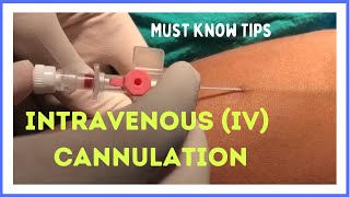 INTRAVENOUS IV CANNULATION in 5 mins How to insert [upl. by Imerej]