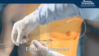 SICD Implant Procedure Animation [upl. by Matthias]