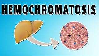 Hemochromatosis [upl. by Josi]